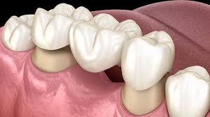 This image is about the fixed dental bridges dentist in Sodepur