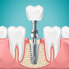 This image is about the pain-free dental implants in Khardah