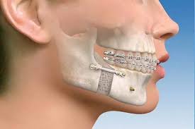  This image is about the top treatment of jaw fracture in Khardah