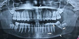  This image is about the top treatment of jaw fracture in Khardah