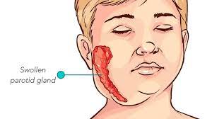  This image is about the best parotid swelling treatment in North Kolkata
