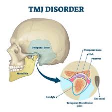 This image is about the TMJ disorders treatment in North Kolkata