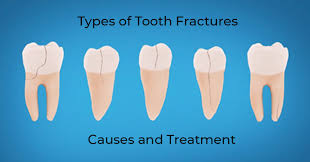 This image is about the best treatment of tooth fracture in North Kolkata