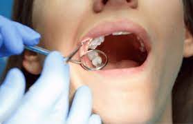 This image is about the wisdom tooth removal cost in North Kolkata 